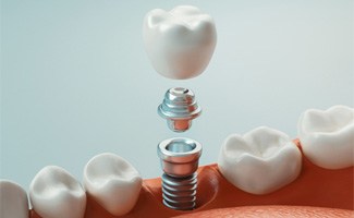 a digital illustration showing the parts of a dental implant