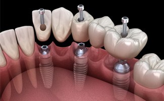 :a digital illustration depicting an implant bridgen
