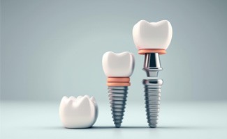 : a digital illustration showing the parts of a dental implant