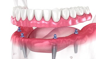 a digital illustration of a denture being attached to implants