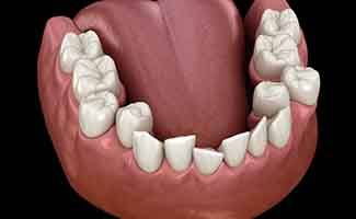 Illustration of crowded teeth