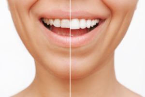 a veneers before/after photo